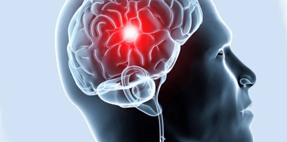 порушення мозкового кровообігу